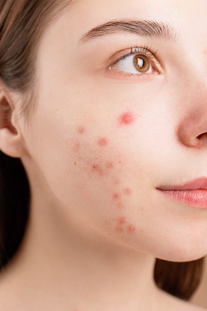 Close-up of acne-prone skin before treatment