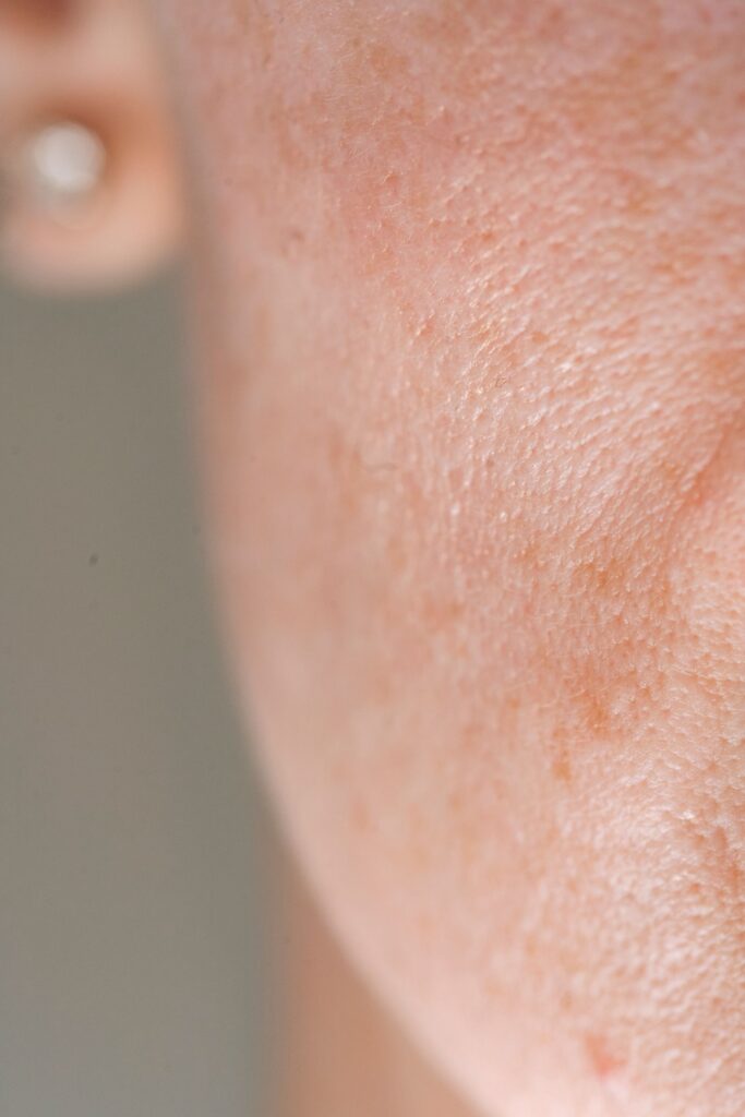 Close-up of skin texture for acne scar treatment